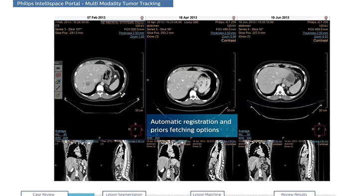 multi modality tumor tracking youtube video thumbnail