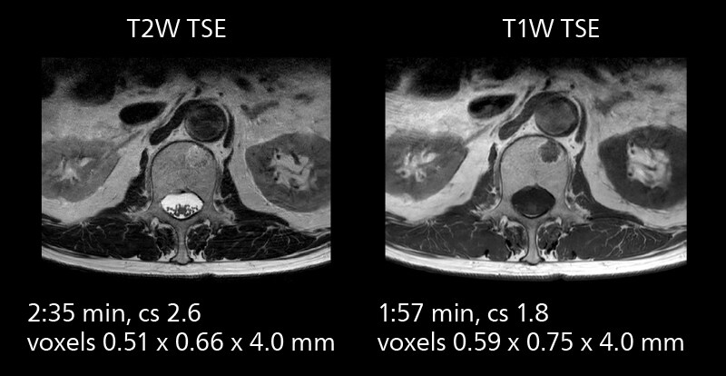 Lumbar spine mri three