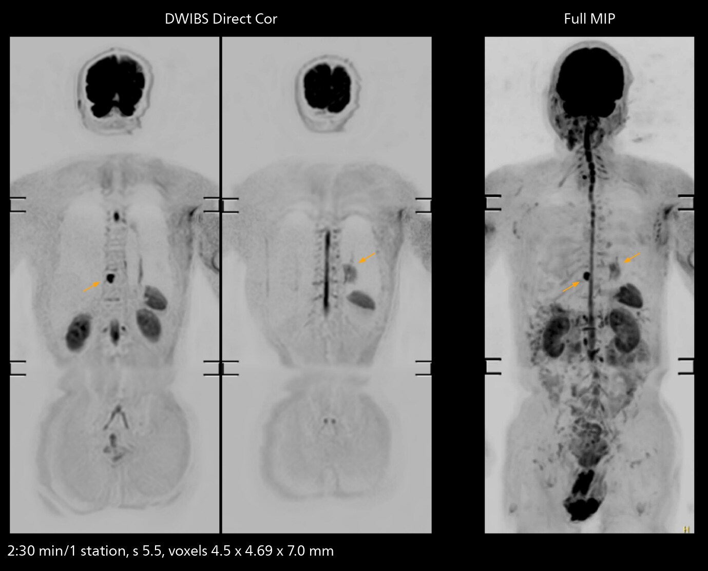 Whole body mri two