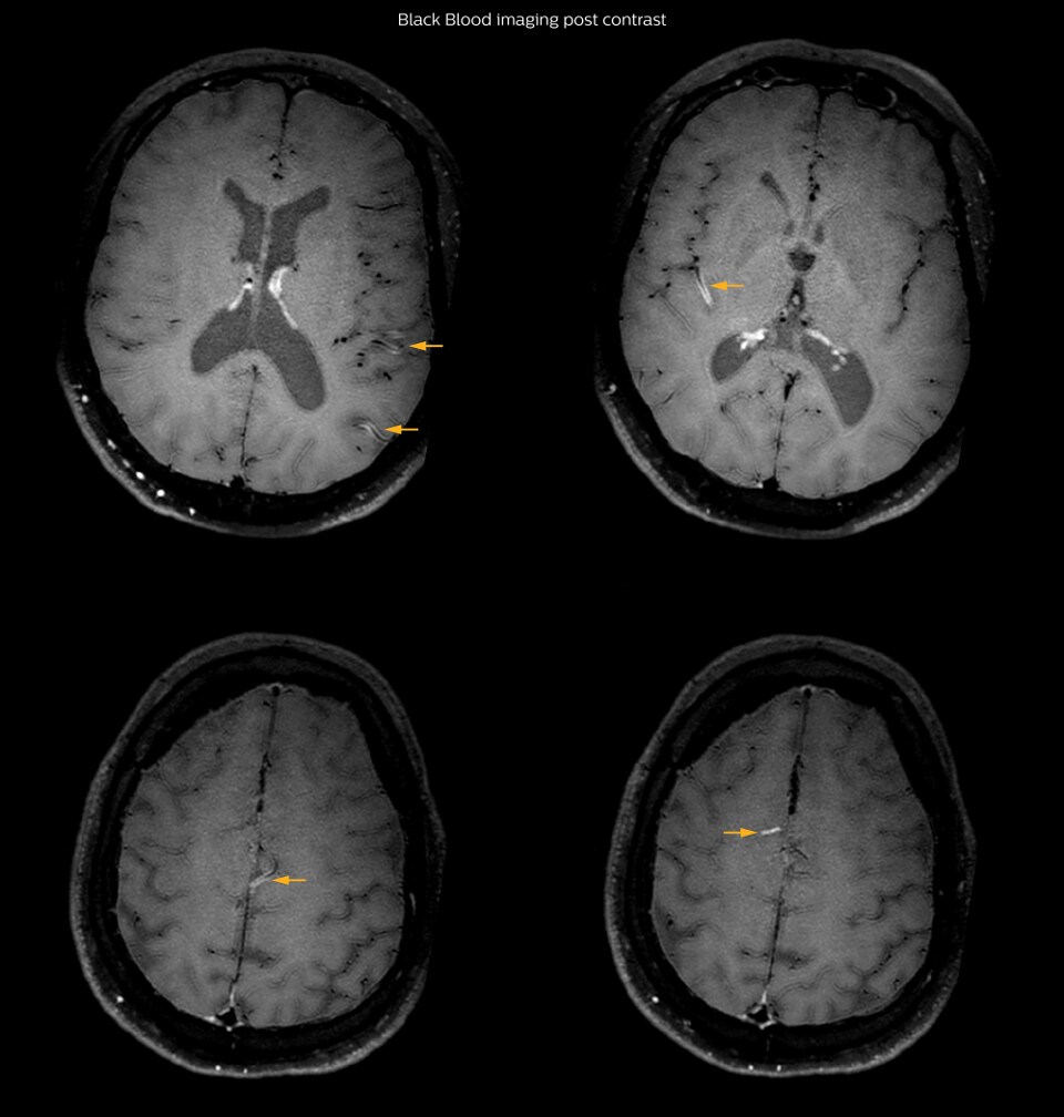 Black Blood Imaging Case 1 C Post contrast1