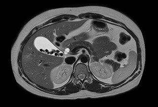 MCVI VitalEye ascites