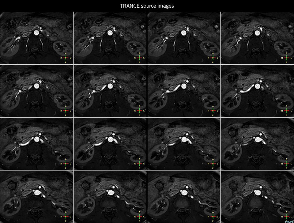 Non-contrast MRA of renal arteries