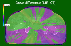 Turku Dose difference MR-CT case 9