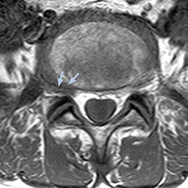 MRI of right L5 radiculopathy