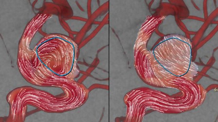 Aneurysmflow blood flow diverter deployment