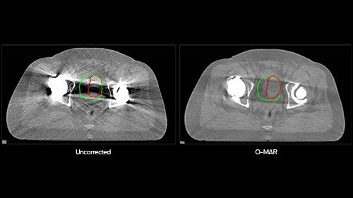 bladder contour L