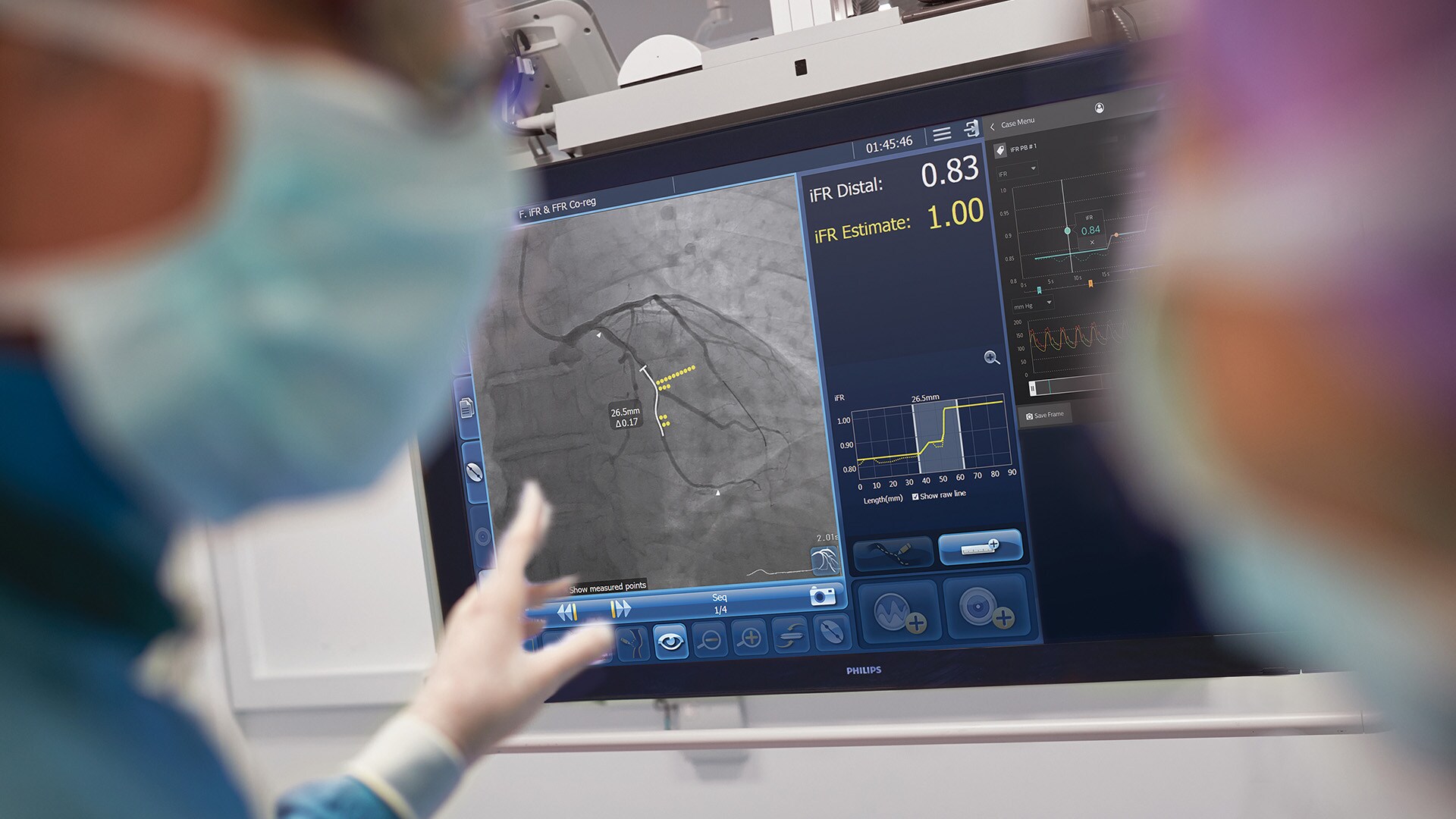 Philips thông báo bệnh nhân đầu tiên đăng ký tham gia nghiên cứu trung tâm toàn cầu DEFINE GPS để đánh giá tính ưu việt của các quy trình PCI được dẫn hướng bởi iFR và chụp mạch can thiệp đồng đăng ký