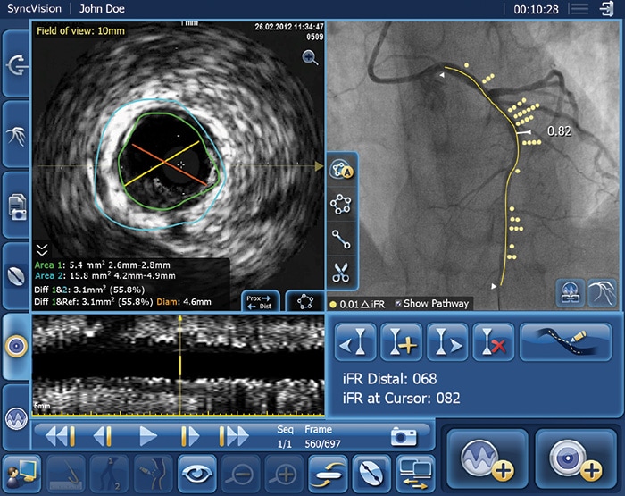 Download image (.jpg) iFR data co-registered on the angiogram