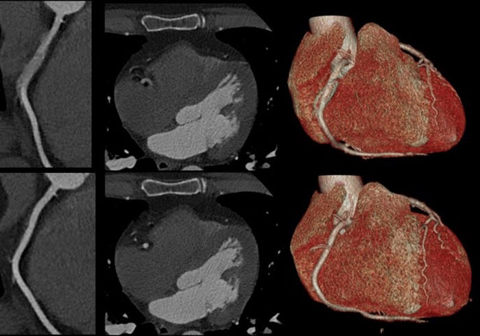 Download image (.jpg) Spectral CT 7500 Motion in Right Coronary Artery Comparison