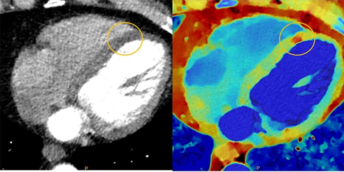 Download image (.jpg) Spectral CT 7500 Myocardial Perfusion Comparison