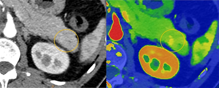 Download image (.jpg) Spectral CT 7500 Pancreatic Lesion Comparison
