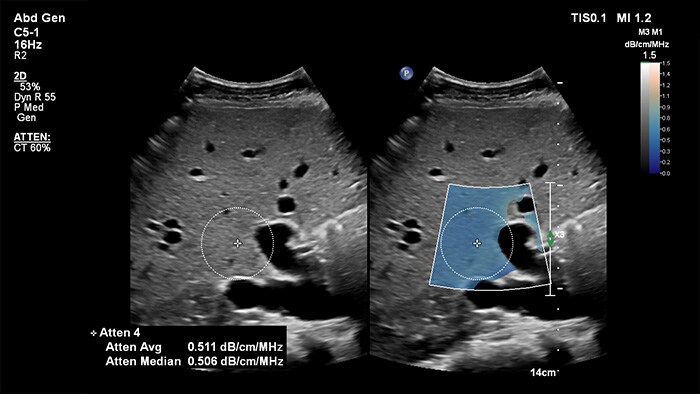 Download image (.jpg) (opens in a new window) EPIQ Ultrasound attenuation imaging 2