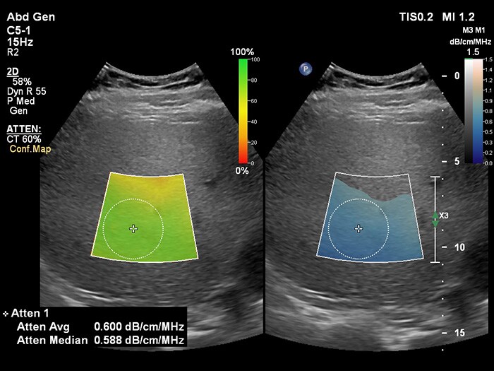 Download image (.jpg) (opens in a new window) EPIQ Ultrasound attenuation imaging 1 