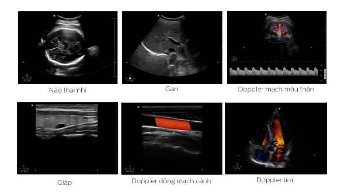 ultrasound system