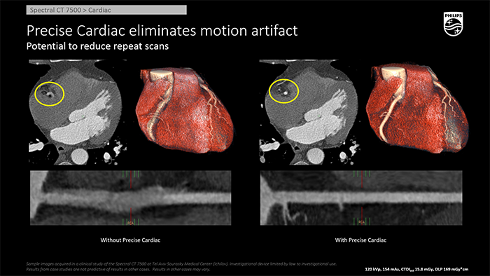 Phần mềm Precise Cardiac